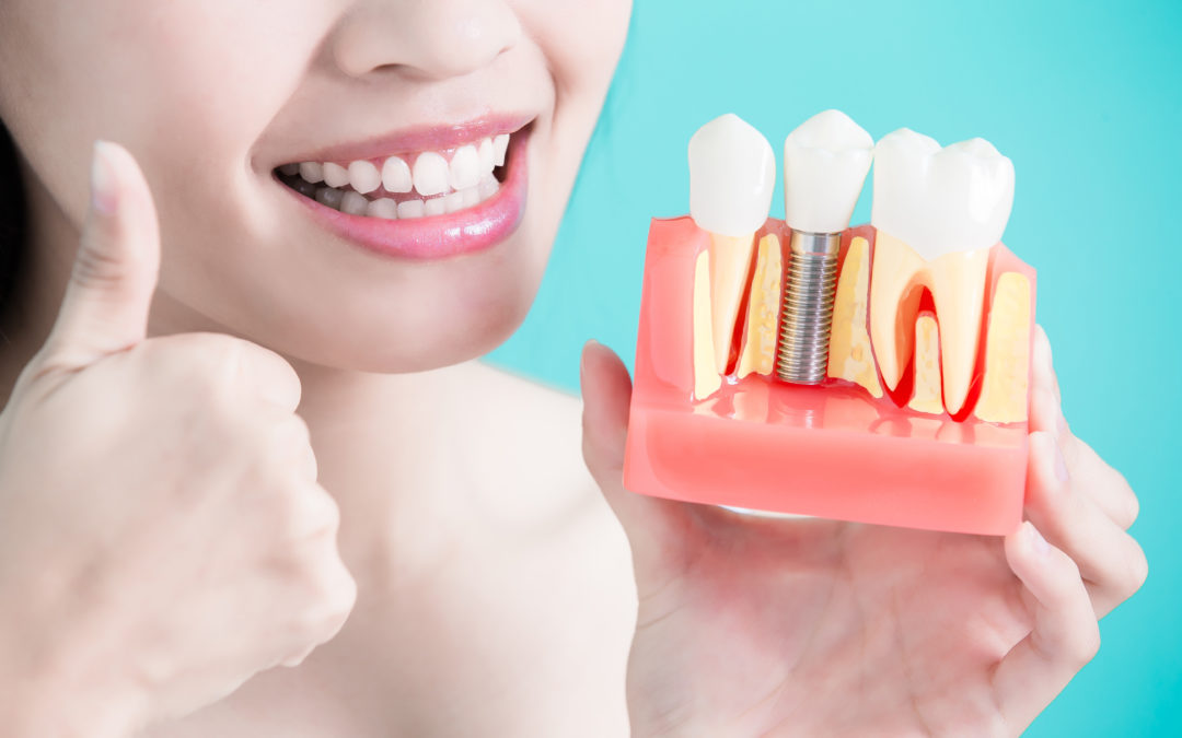 4 Essential Tips to Taking Care of Your Dental Implants