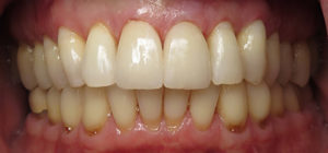 Close up of a mouth after Porcelain Veneers