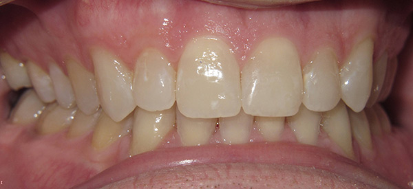 Close up of a mouth after Teeth Whitening