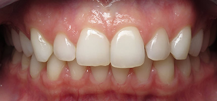 Close up of a mouth before Composite Bonding
