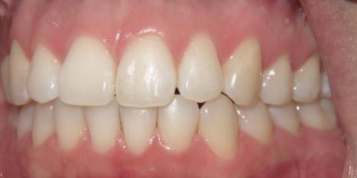 Close up of a mouth after Invisalign straightening