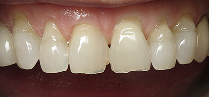 Close up of a mouth before Bioclear