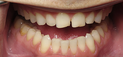 Close up of a mouth before Bioclear