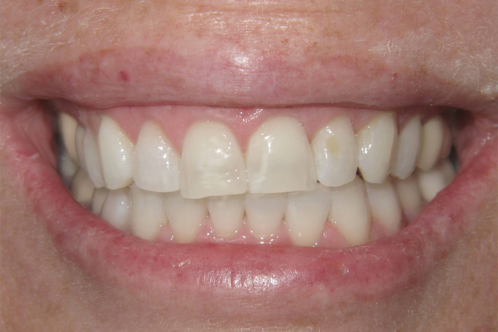 Close up of a mouth after Teeth Whitening
