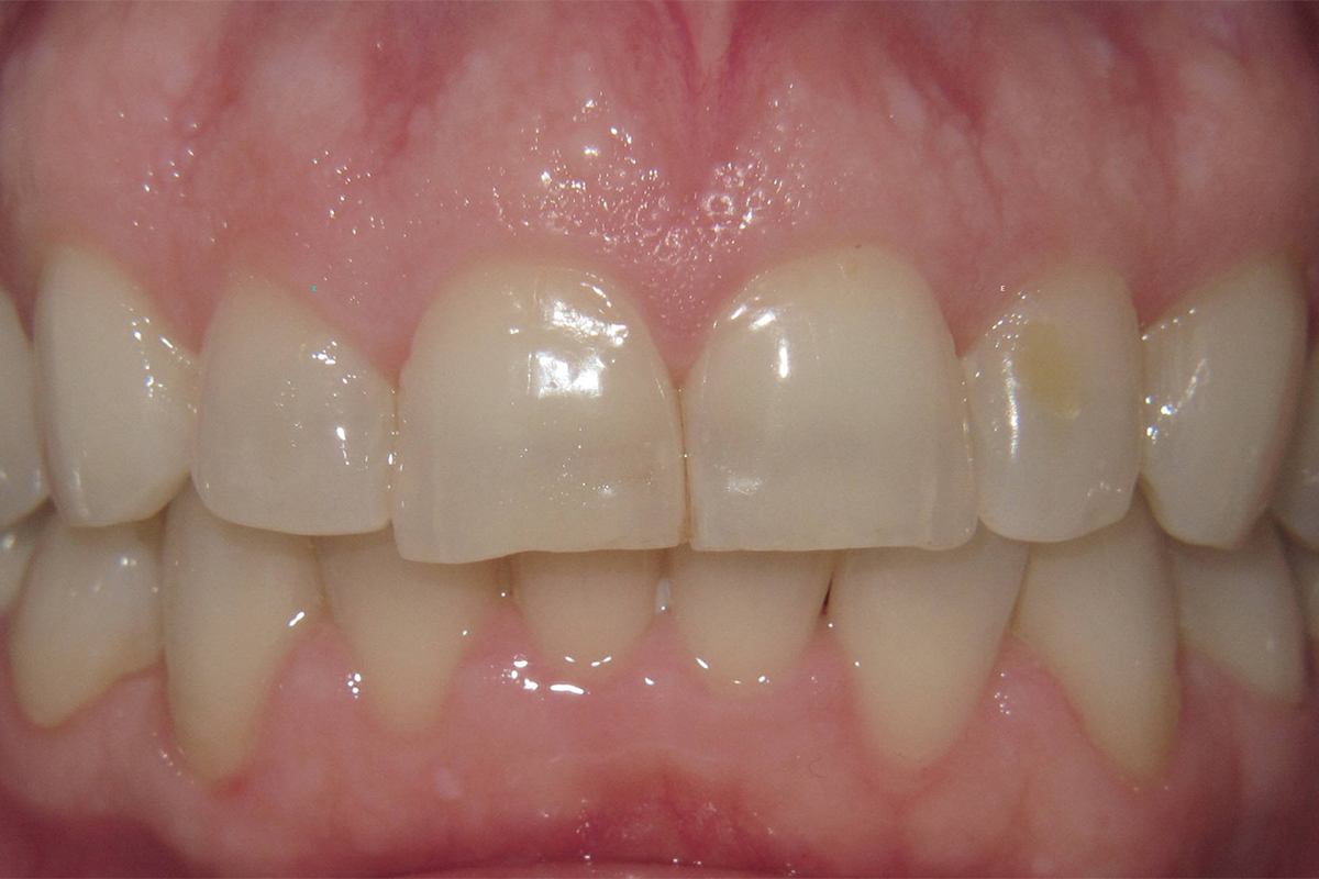 Close up of a mouth before Teeth Whitening