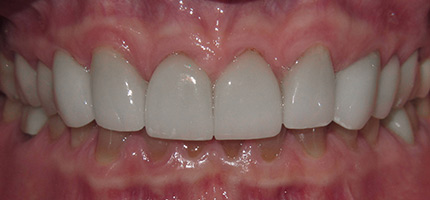 Close up of a mouth after smile rejuvenation