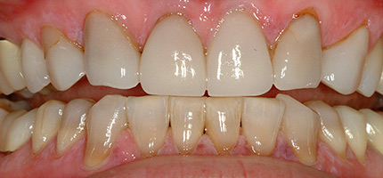 Close up of a mouth before smile rejuvenation
