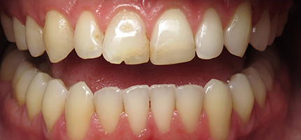Close up of a mouth before smile rejuvenation