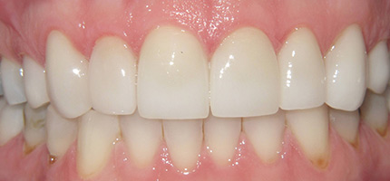 Close up of a mouth after smile rejuvenation