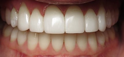 Close up of a mouth after Bioclear