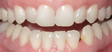 Close up of a mouth before Invisalign straightening