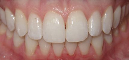 Close up of a mouth before Invisalign straightening
