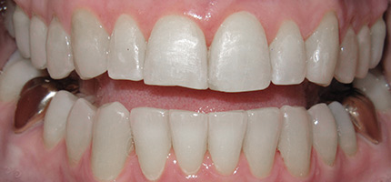 Close up of a mouth after Invisalign straightening