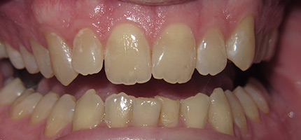 Close up of a mouth before bleach