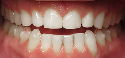 Close up of a mouth after Composite Bonding
