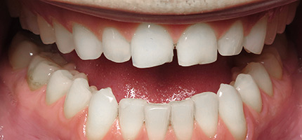 Close up of a mouth before Composite Bonding