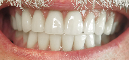 Close up of a mouth after cosmetic dentures